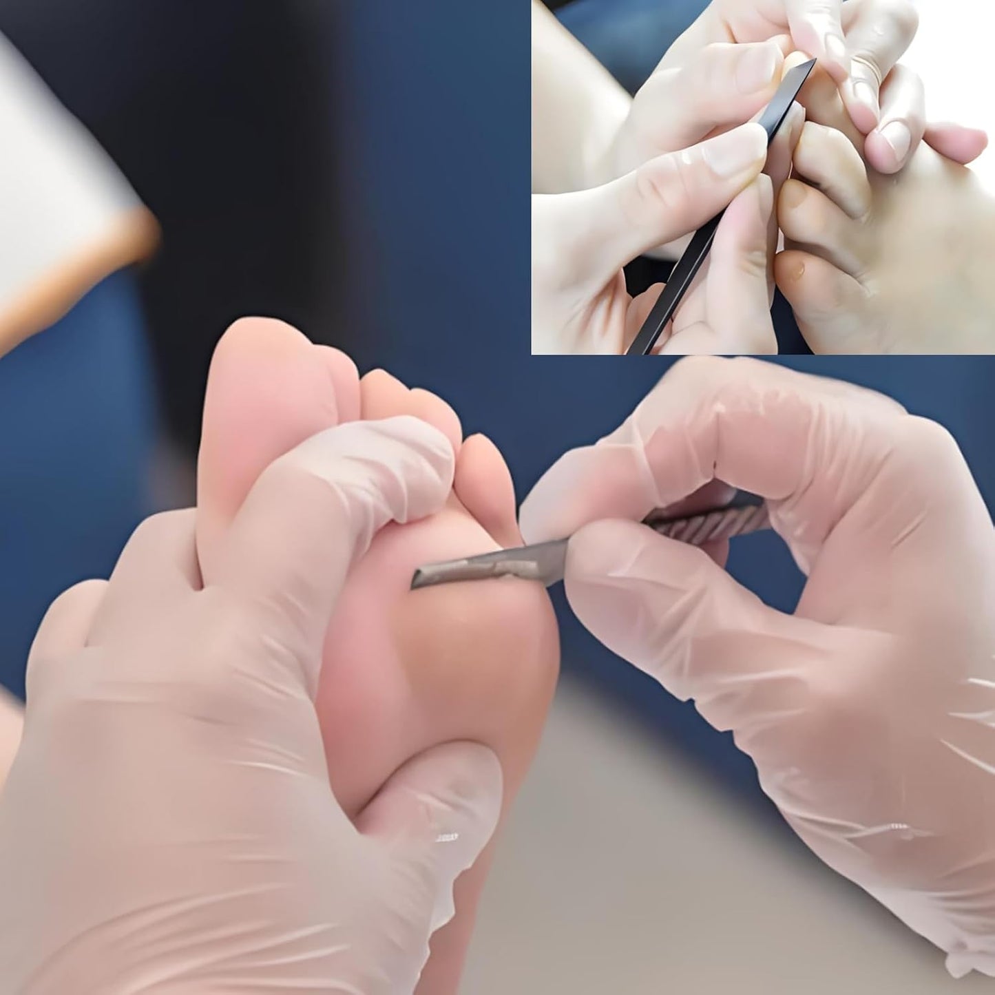 Stainless steel ingrown toenail pedicure knife set,professional foot skin scraper repair sharp blade kit for nail corn callus paronychia treatment. (2)